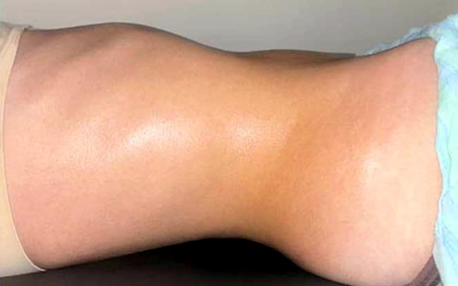 Après drainage lymphatique corps