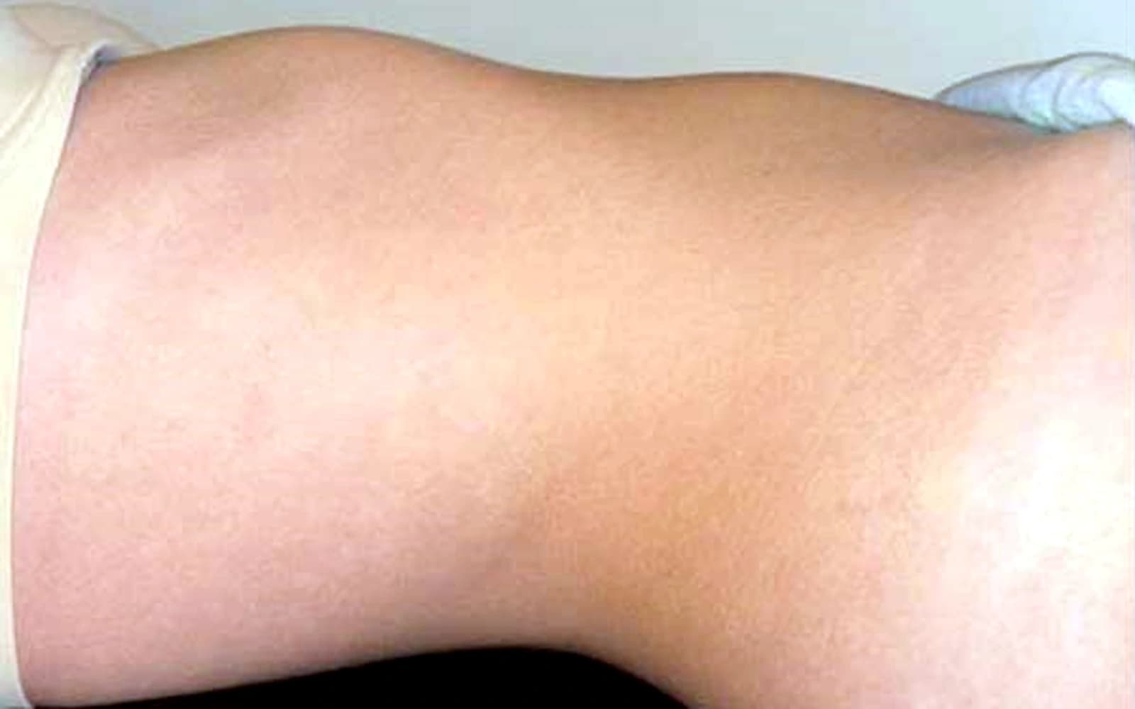 Avant drainage lymphatique corps